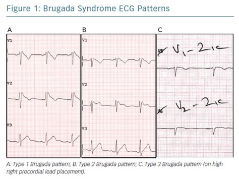 Brugada Syndrome ECG Patterns | AER Journal