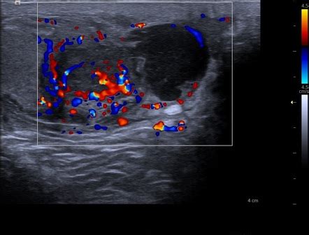 Epididymitis Ultrasound