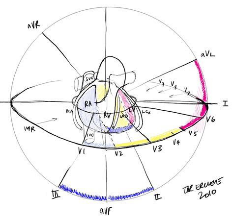 The Art of Infarct Localisation • LITFL