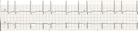 Supraventricular Ectopic Beat