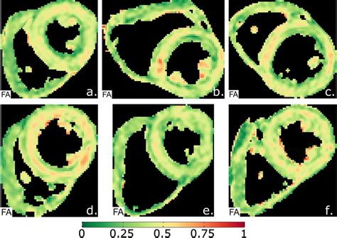 Typical examples of fractional anisotropy (FA) maps, which show a... | Download Scientific Diagram