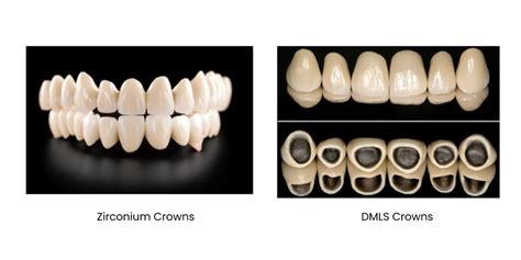 DMLS vs ZERCONIUM CROWMS WHICH & WHY...? - V Dental Care