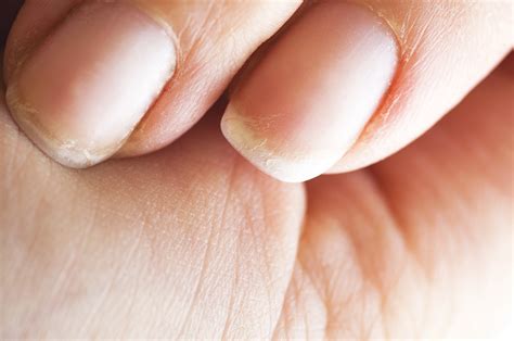 Peeling Nails? Here’s 8 Reasons Why it’s Happening