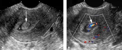 Endometrium | Radiology Key