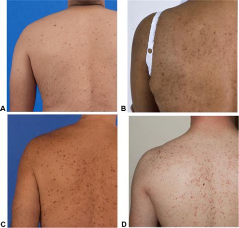 Maculopapular Cutaneous Mastocytosis in a Diverse Population - The Journal of Allergy and ...