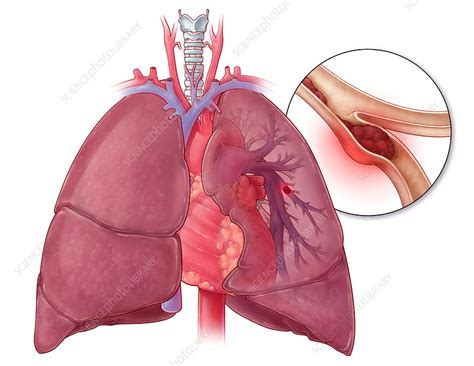 Tin Tức Cao Niên Thế Kỷ XXI: Những Triệu Chứng Cần Lưu Ý Cho Người Cao Tuổi