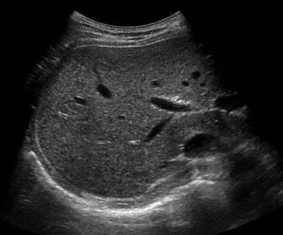 Visualization score A. A 60-year-old male with chronic hepatitis B ...