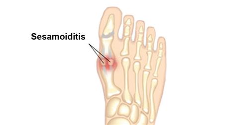 Sesamoiditis Symptoms & Treatment