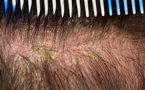 Scalp Eczema: Causes, Symptoms, Treatments & Preventive Tips – Vedix