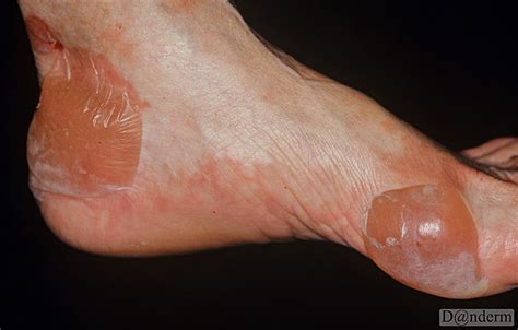 epidermolysis bullosa - pictures, photos