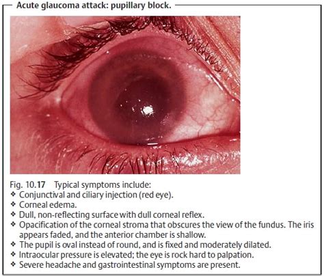 Neovascularization in the Iris: Rubeosis Iridis