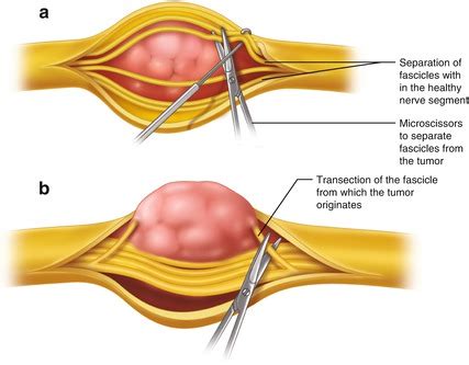 Nerve Tumors | Neupsy Key