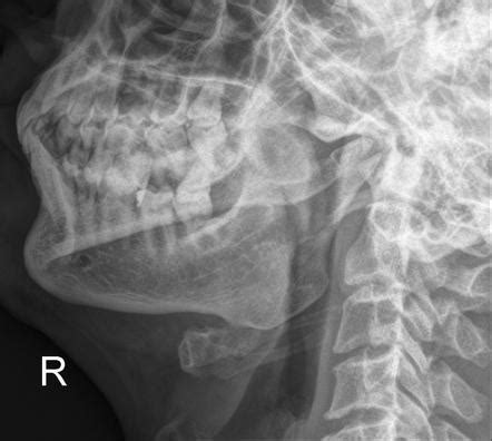 Mandible (axiolateral oblique view) | Radiology Reference Article ...