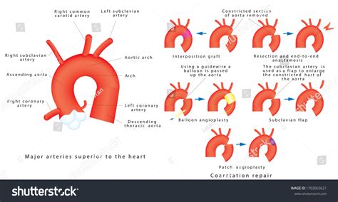 Coarctation Repair Coarctation Aorta Congenital Defect Stock Vector (Royalty Free) 1703065621 ...