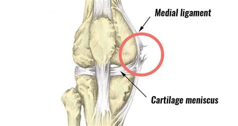 Inside knee pain Archives - Sportsinjuryclinic.net