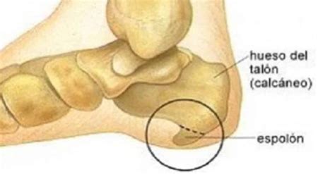 Aprenda un tratamiento para el espolón calcáneo con una receta casera
