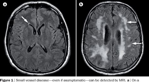 small vessel ischemic disease Cerebral csvd vascular svn bmj - Diseases Club Center 2