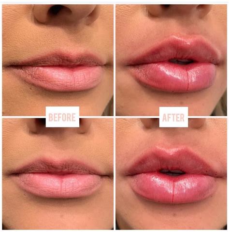 Dermal Fillers Lips, Botox Fillers, Lip Fillers, Lip Injections Juvederm, Botox Lips, Juviderm ...