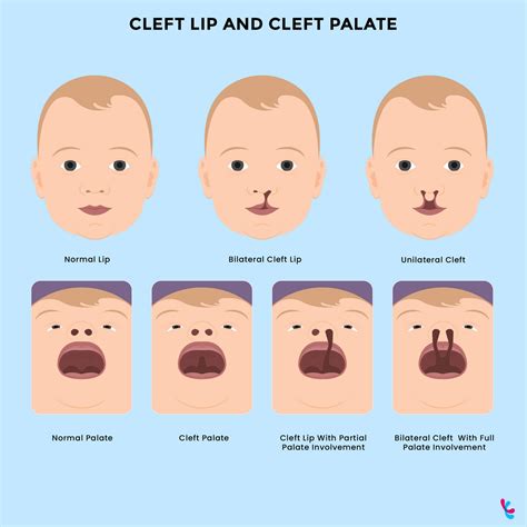 Is Cleft Lip Genetic? Facts about Cleft Lip and Palate