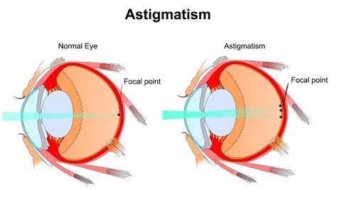 All about astigmatism glasses: do you need it?