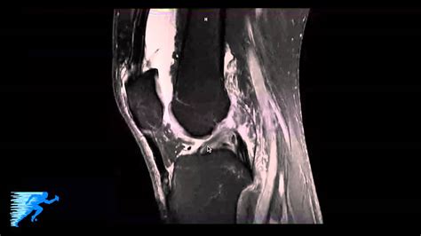 Fibular Collateral Ligament Mri