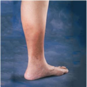 Tired, heavy legs may indicate CVI | Health24