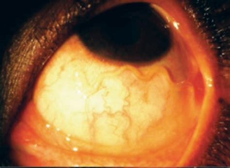 Loa Loa Filariasis (African Eye Worm): What is it?! | Ophthalmology ...