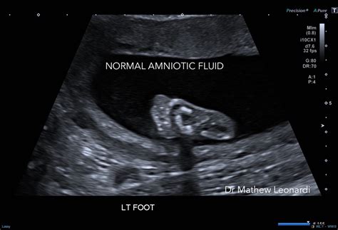 SUGO | Fetal Wellbeing / Biophysical Profile