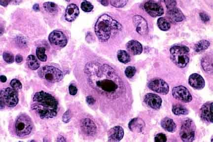 Immunoblastic Lymphoma: Images