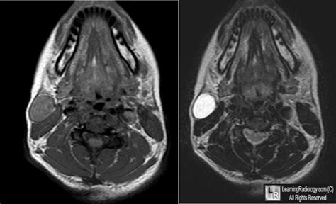 LearningRadiology - branchial, cleft, cyst, 2nd, 2, second, II, ct ...