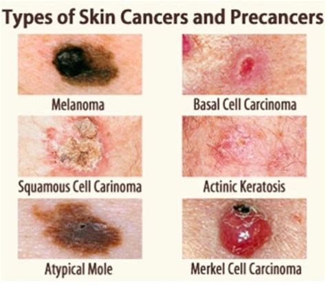 What Types Of Skin Cancer Are There
