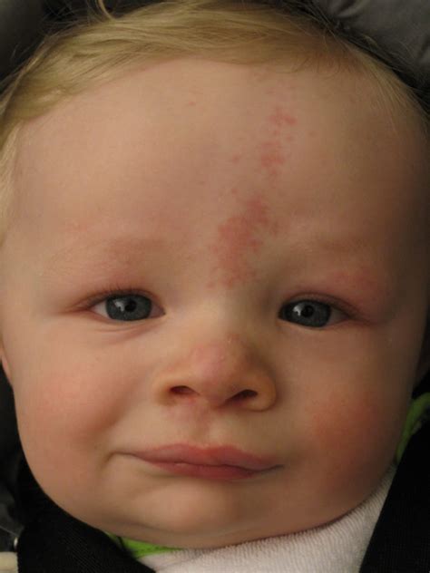 Common Birthmarks - Dermatology Advisor