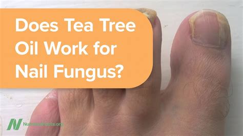 Does tea tree oil cure toenail fungus