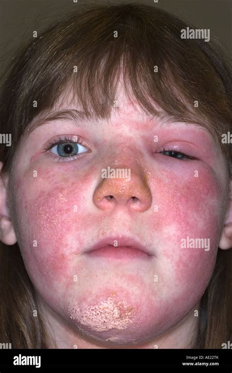 Rhus dermatitis hi-res stock photography and images - Alamy