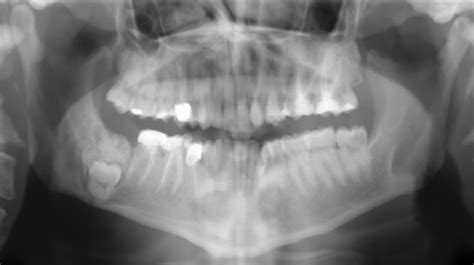 Radiopaque Mandibular Lesions