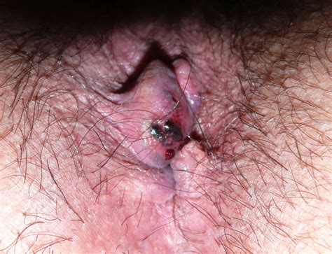 Thrombosed Hemorrhoid Skin Tag