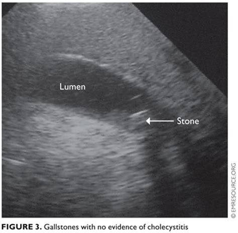 Gallbladder Ultrasound Stones