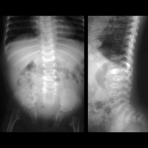 Spondyloepiphyseal Dysplasia Dwarfism