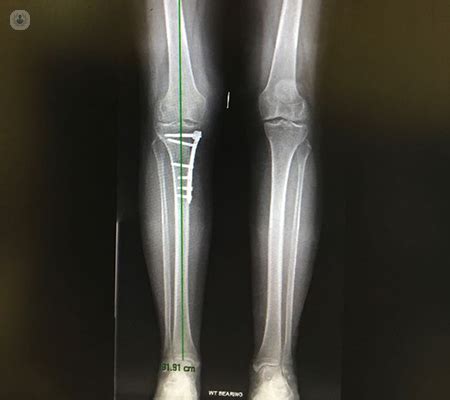 Knee osteotomy vs. knee replacement surgery