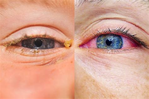 Allergies or Pink Eye: Here's How to Tell the Difference | Reader's Digest