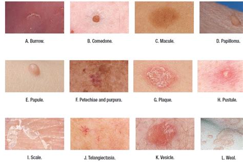 Medical Addicts: Terms used to describe skin lesions