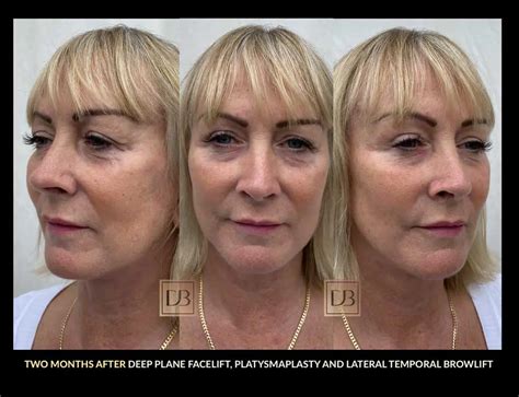 Stages of Facelift Recovery | Dr. Dominic Bray