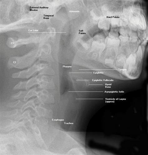 X-ray Soft Tissue Neck Plain X-ray Soft tissue lateral view neck ...