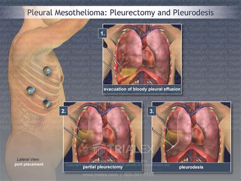 Pleural Mesothelioma: Pleurectomy and Pleurodesis - TrialQuest In...