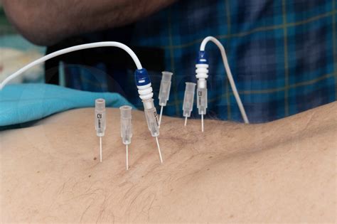 Facet Joint Denervation (lumbar spine) using Abbott IonicRF Generator Surgical Technique ...