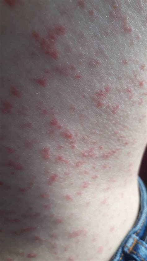 Viral Rash On Arms