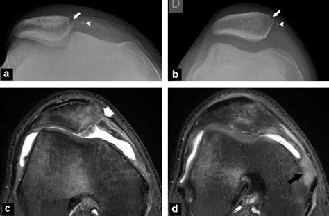 Medial Patellar Retinaculum Injury