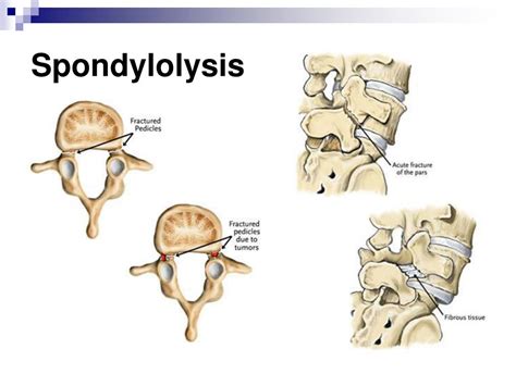 Spondylolysis | www.imgkid.com - The Image Kid Has It!