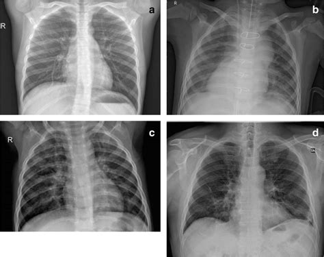 Sample images of the datasets used in this work: healthy lungs (a ...