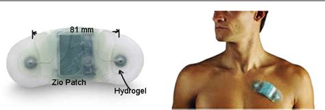 Zio Patch Cardiac Monitoring